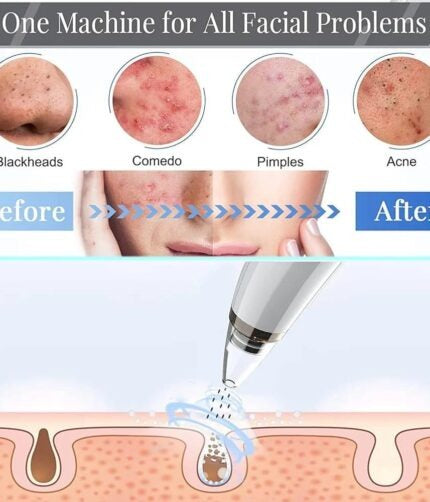 Blackhead Remover Vacuum Acne Cleaner Black Spots Removal